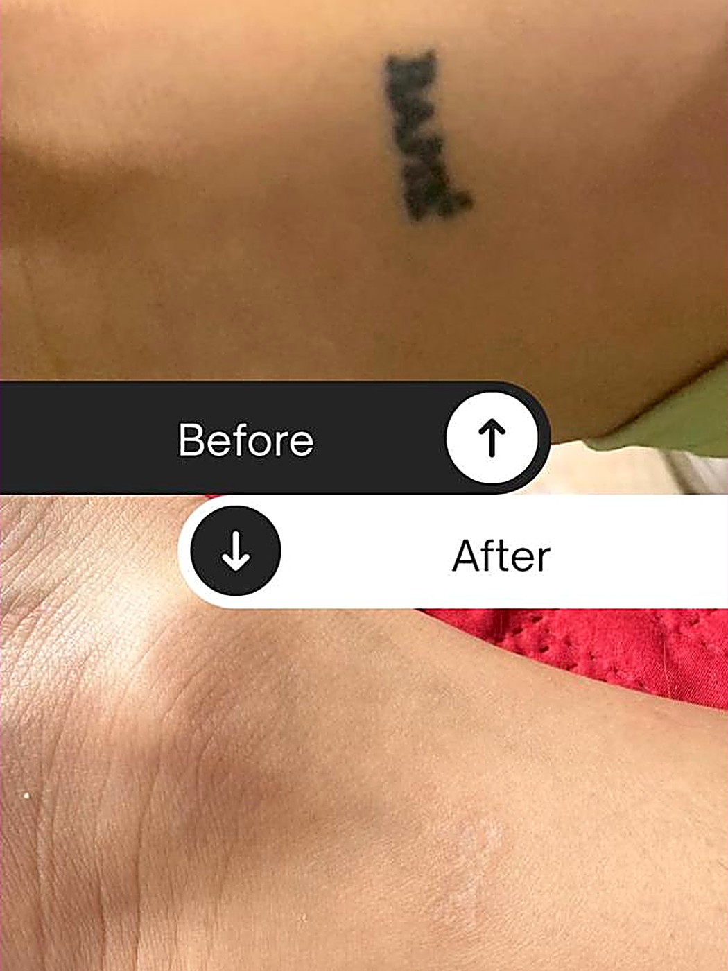 Antes y después: remoción de tatuaje en el hombro