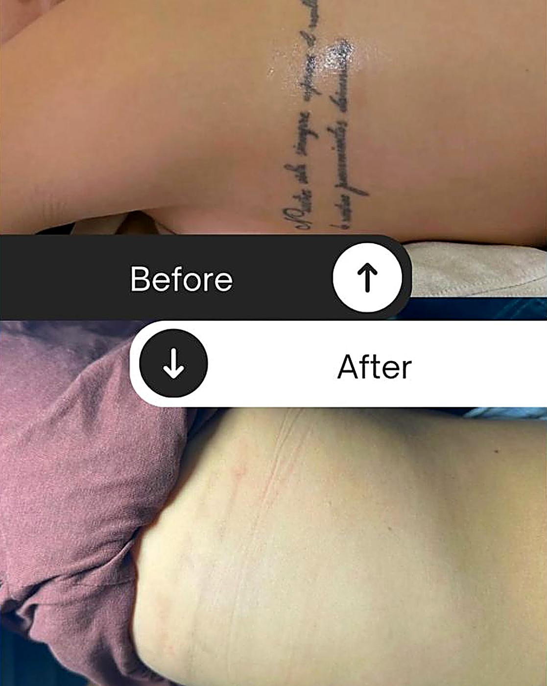 Antes y después: remoción de tatuaje en la espalda